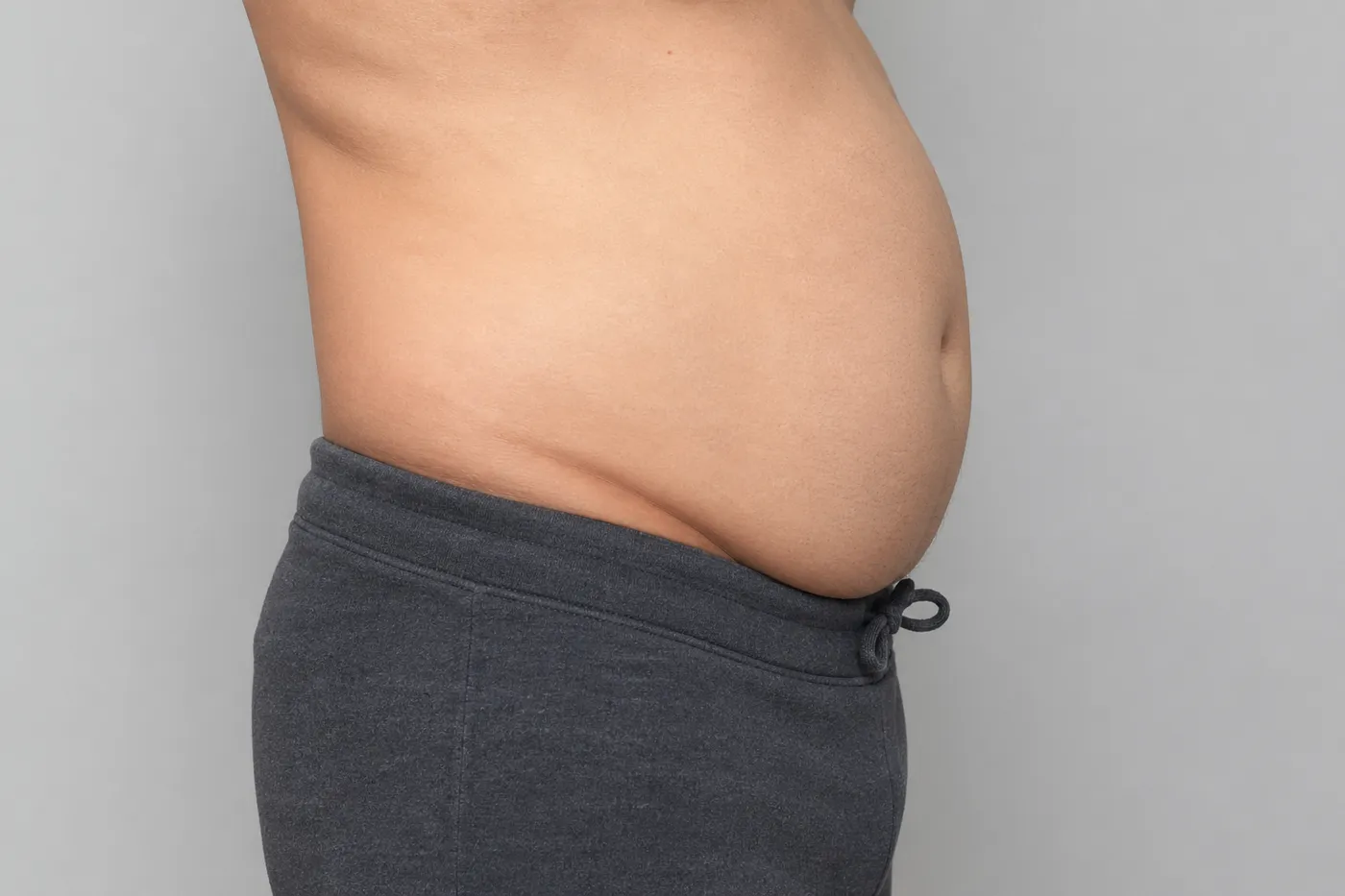 Illustration de la graisse abdominale viscérale et sous-cutanée chez un profil skinny fat avec ventre proéminent